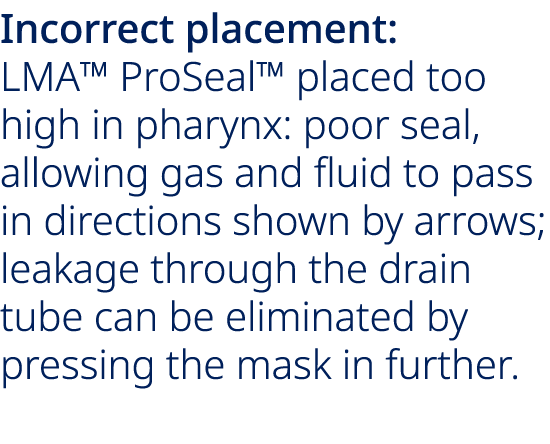 Incorrect placement: LMA™ ProSeal™ placed too high in pharynx: poor seal, allowing gas and fluid to pass in direction...