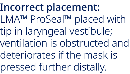 Incorrect placement: LMA™ ProSeal™ placed with tip in laryngeal vestibule; ventilation is obstructed and deteriorates...