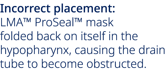 Incorrect placement: LMA™ ProSeal™ mask folded back on itself in the hypopharynx, causing the drain tube to become ob...